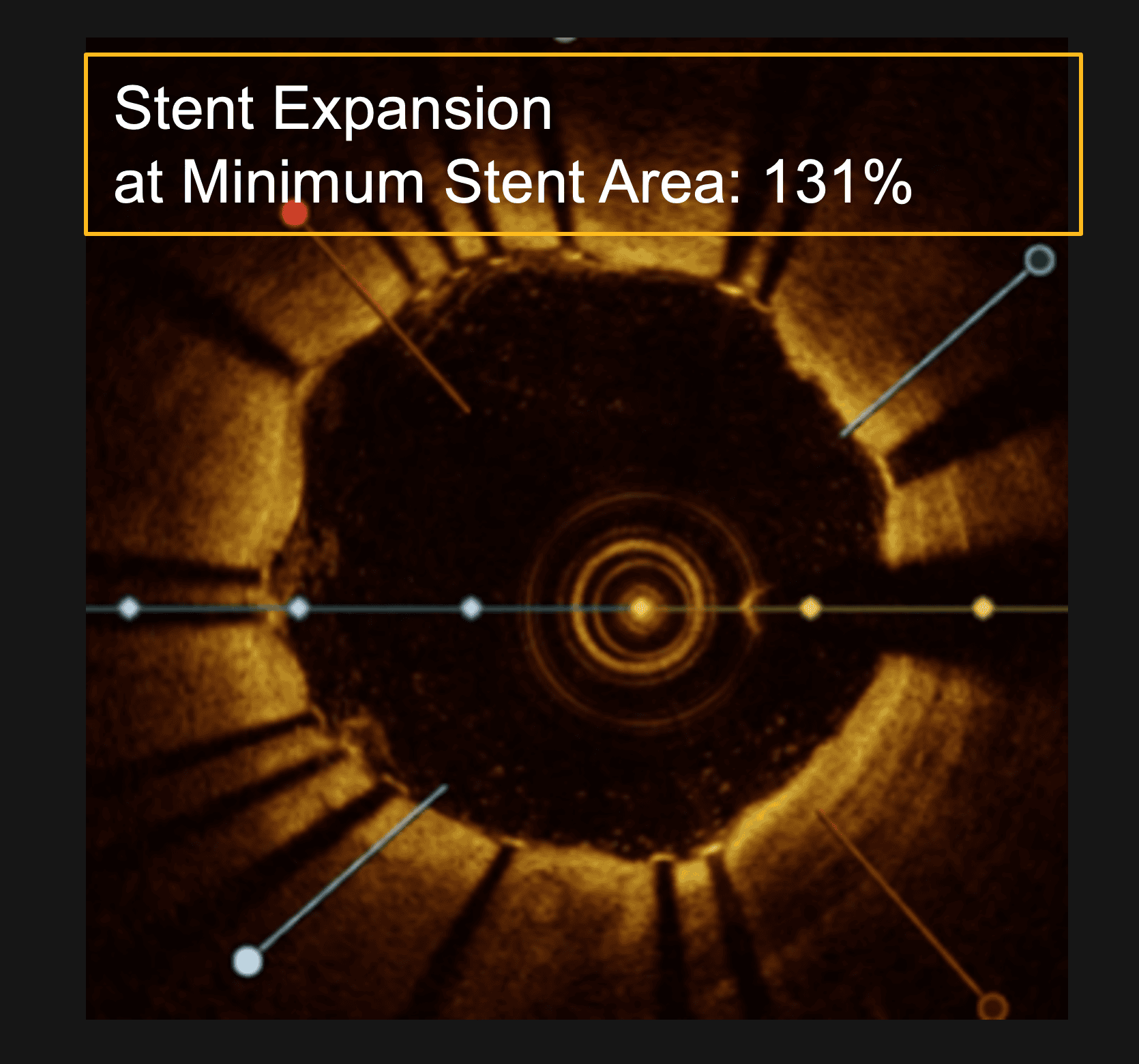 LithiX Final Post-Stent